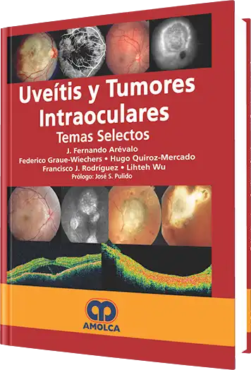 Uveítis y Tumores Intraoculares