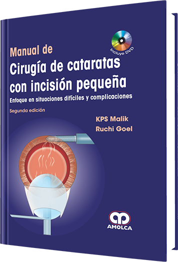 Manual de Cirugía de Cataratas con Incisión Pequeña. 2 Edición