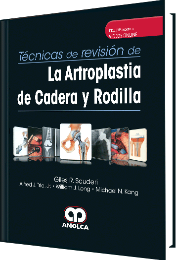 La Artroplastia de Cadera y Rodilla
