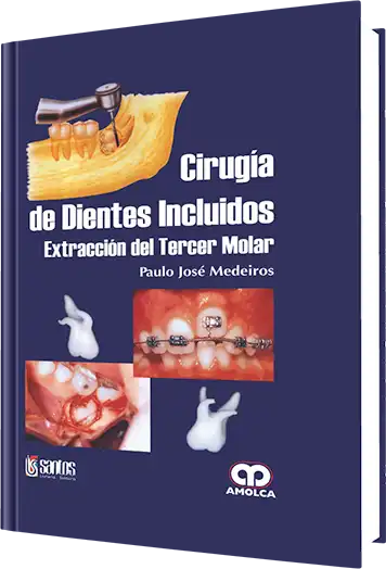 Cirugía de Dientes Incluidos Extracción del Tercer Molar