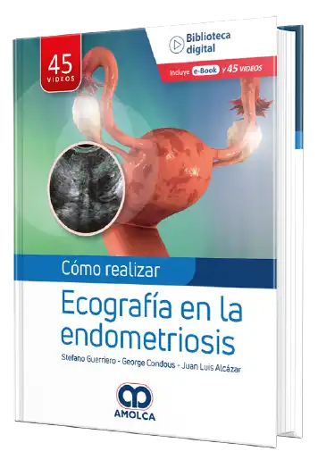 Cómo realizar Ecografía en la endometriosis