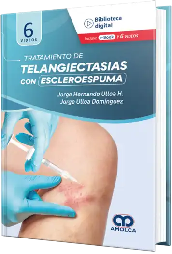 Tratamiento de Telangiectasias con Escleroespuma