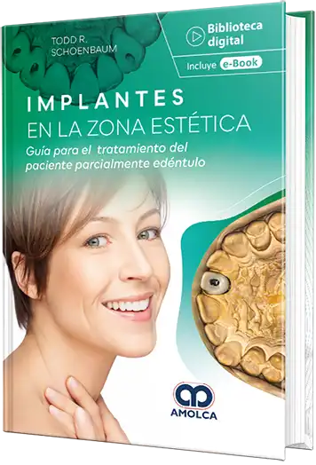 Implantes en la zona estética